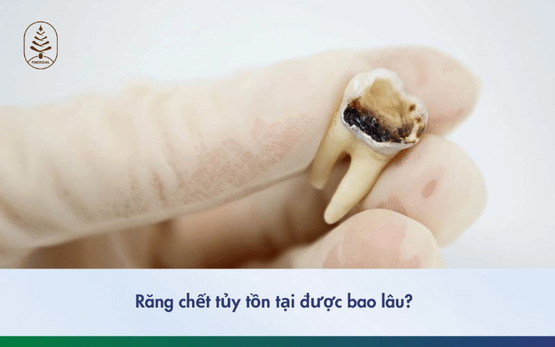 Răng chết tủy tồn tại được bao lâu? Nguyên nhân và cách điều trị hiệu quả