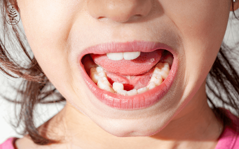 Bé thay răng mọc lệch phải làm sao? Cách điều trị và lời khuyên hữu ích