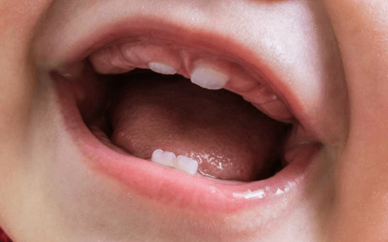 Răng bé mọc lệch vào trong: Nguyên nhân, tác động và cách điều trị hiệu quả