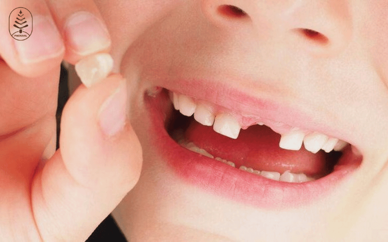 Bé thay răng cửa lâu mọc: Nguyên nhân và cách chăm sóc hiệu quả