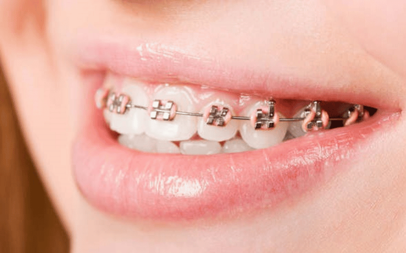 Niềng răng có ảnh hưởng gì không?